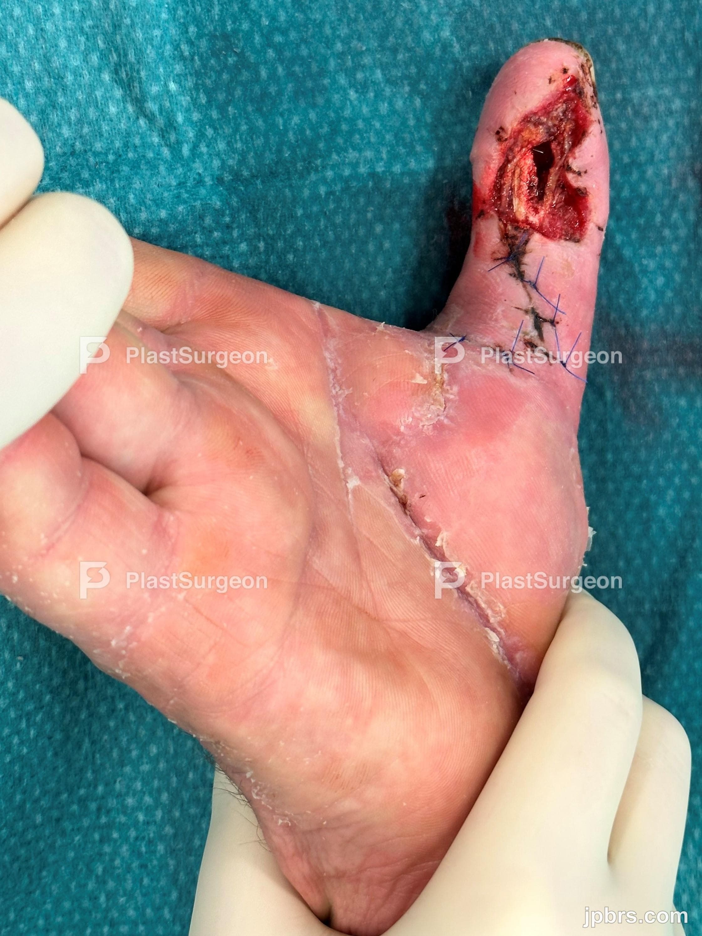 Case 10 (2023): 1st dorsal intermetacarpal artery flap (Foucher flap)