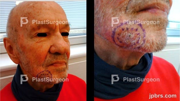 Case 12 (2023): Bilobe flap for mandibular border reconstruction after BCC excision