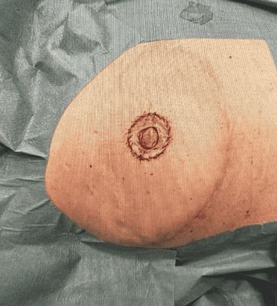 Case 04 2026: Full-Thickness Skin Graft for Areola Reconstruction: A Simple and Reliable Technique