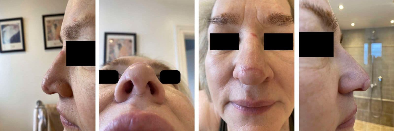 Case 05 2026: Partial avulsion of the nasal tip