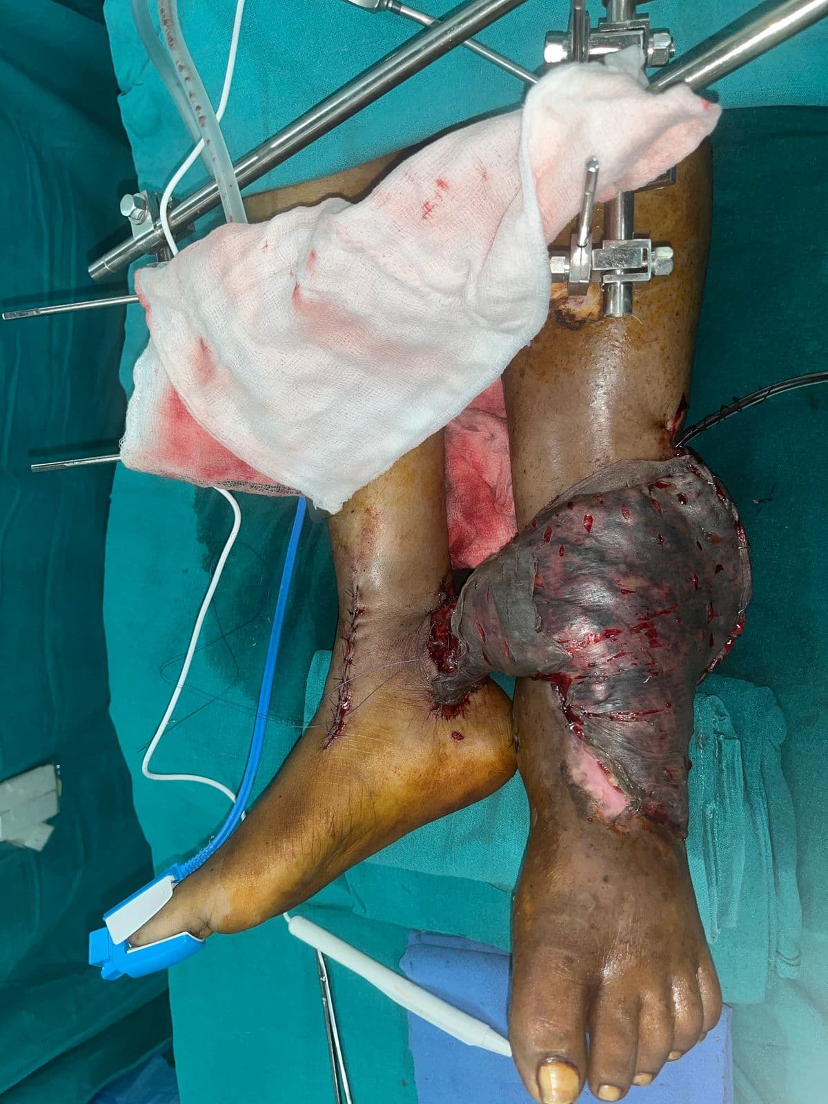 Case 06 2026: Post-Embolic Gangrene of the Left Lower Limb Managed with Serial Debridement, VAC Therapy, and Cross-Leg Free Flap Reconstruction for Limb Salvage