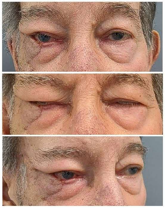 Case 08 2026: A Hella Lamella: A Three-Flap, Full-Thickness Lower Eyelid Reconstruction