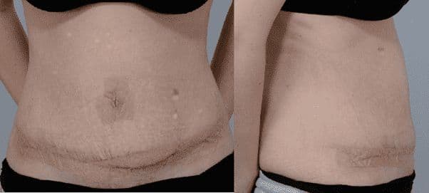 Case 10: Plication of rectus diastasis 2 years after twin-birth