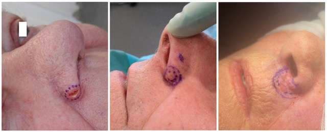 Case 13: Advancing Nasal Ala Reconstruction: Novel Single-Stage Bullhorn Flaps vs. Traditional Two-Stage Nasolabial Techniques