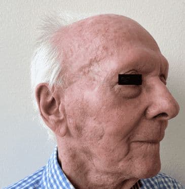 Case 11: Closure of a larger defect on the cheek with the versatile bilobed flap