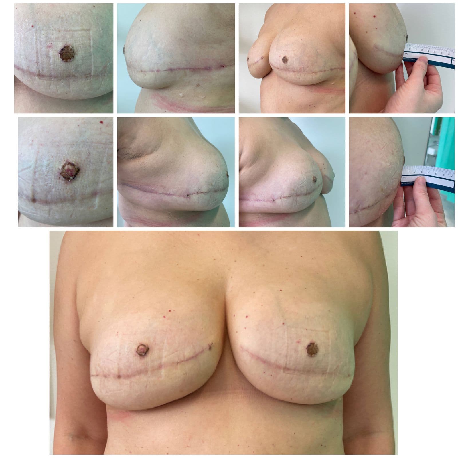 Case 12: Flower Flap - A Novel Papilla Reconstruction Technique Using Local Flaps and Skin Graft