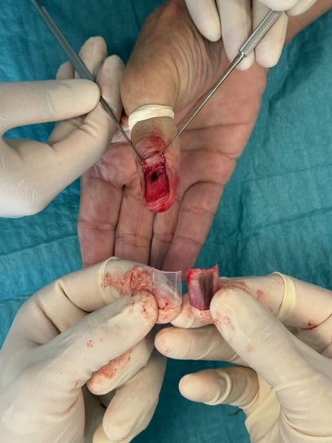 Case 14 2026: Nail removal and punch biopsy - Subungual Melanoma