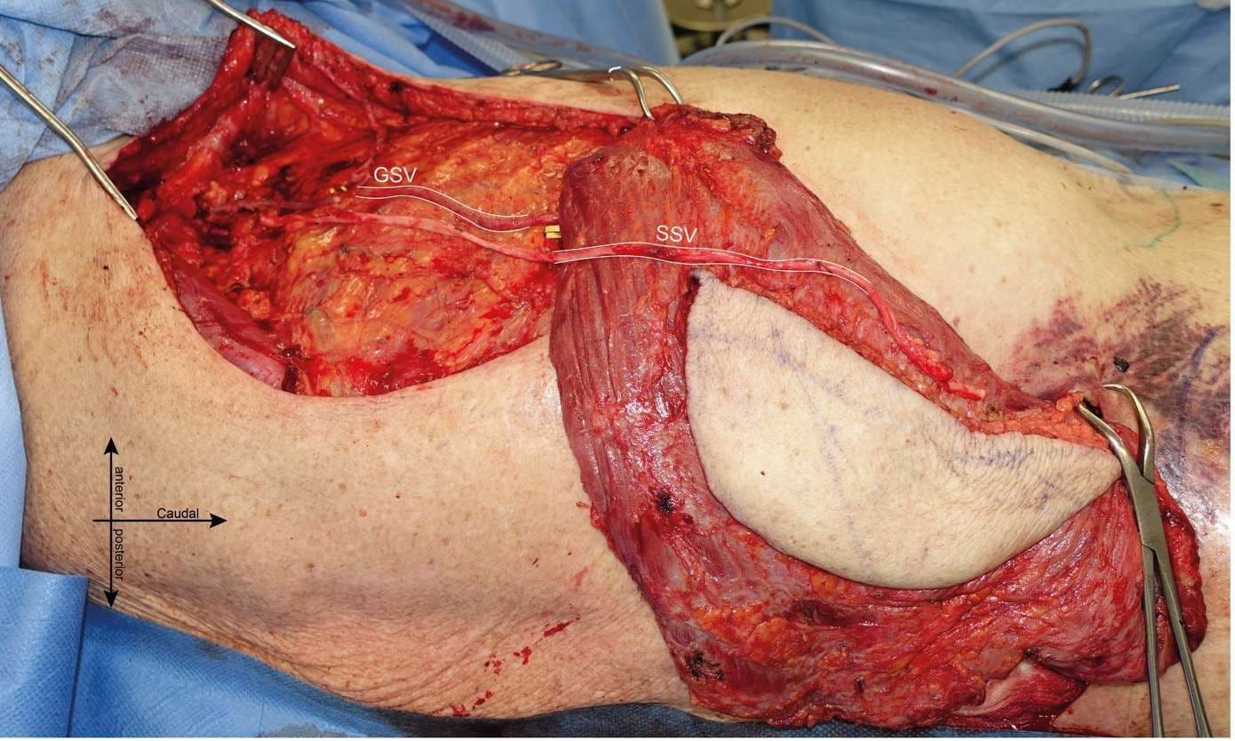 Case 14: Pushing Beyond Anatomical Boundaries: Latissimus Dorsi Sliding Flap for Lower Thoracic Wall Reconstruction