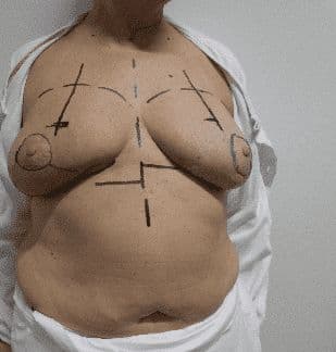 Case 15 2026: The Goldilocks mastectomy