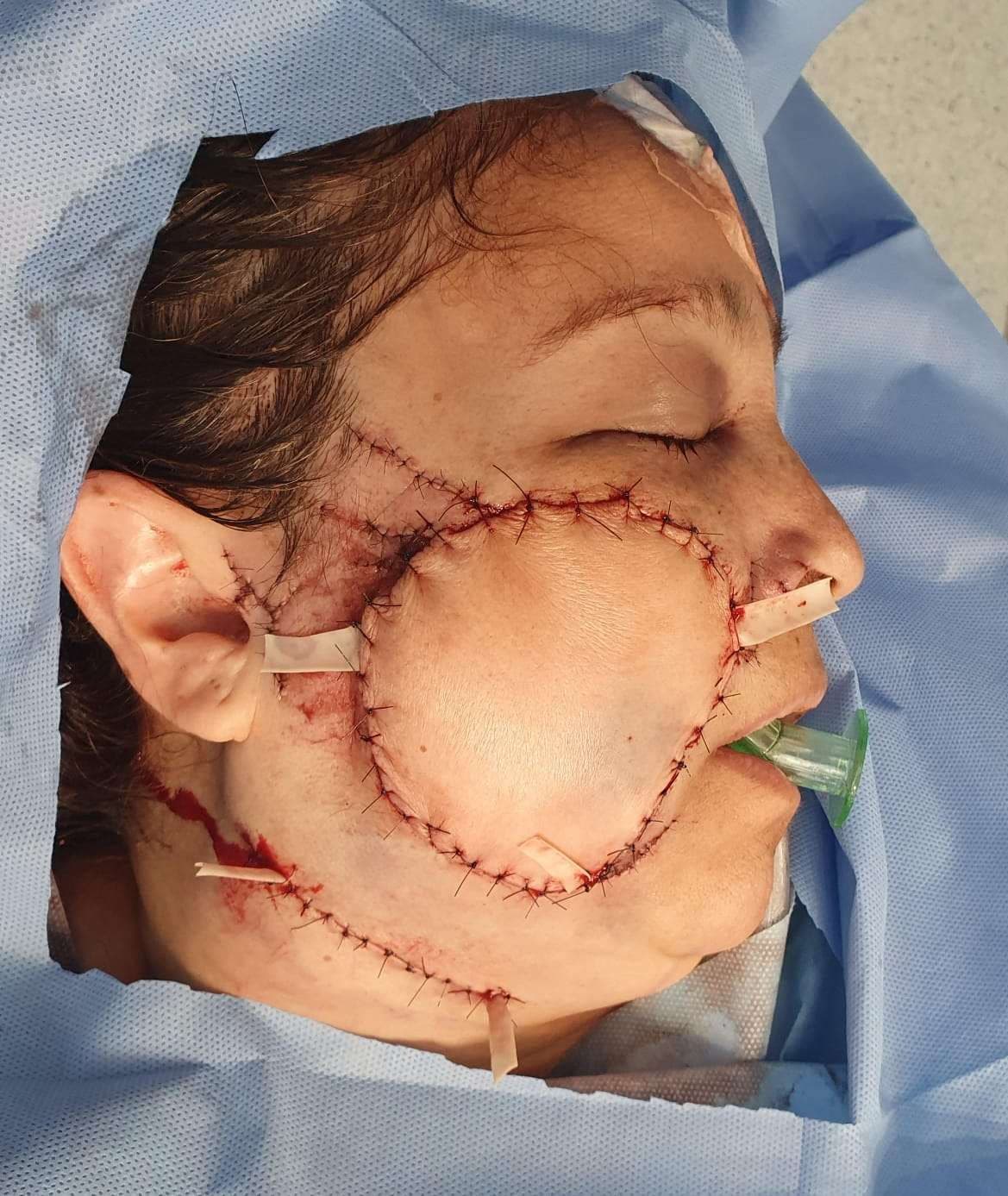 Case 15: Closure of a complex defect after a dog bite wound of the middle third of the face