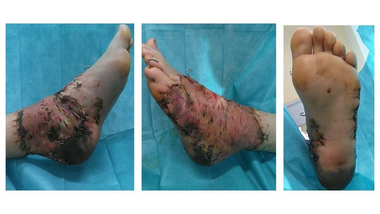 Case 16 2026: Severe Foot Degloving Injury Following a Forklift Crush: A Limb-Salvage Case