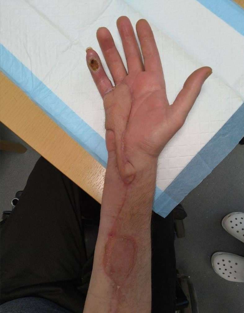 Case 16: Utilizing the reverse radial forearm flap for burn wound management of the hypothenar part of hand