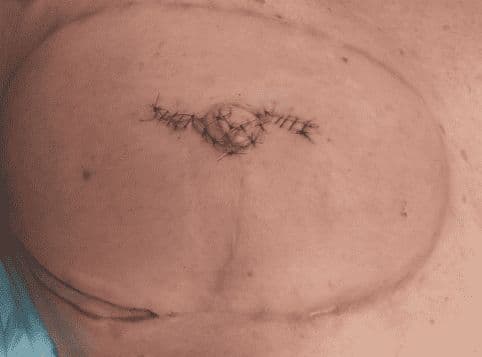 Case 17 2026: Papilla Reconstruction Using the Tennessee Flap Following DIEP Flap Breast Reconstruction