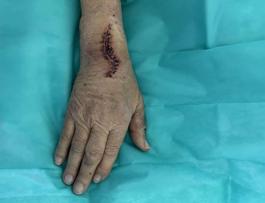 Case 17: Immediate Proximal Row Carpectomy for combined Scaphoid and Lunate Dislocation Without Fracture