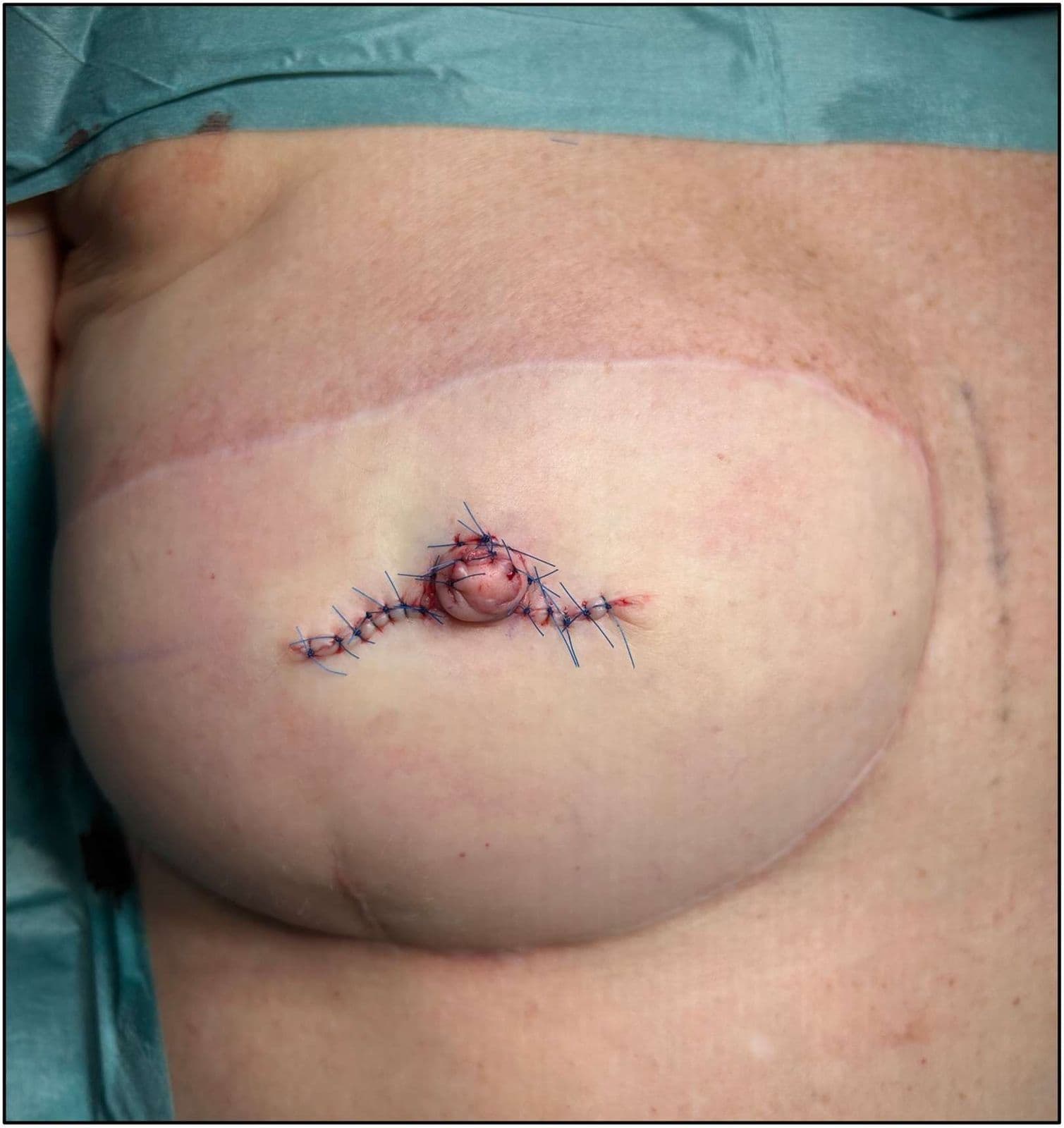 Case 18 2026: Nipple reconstruction on a DIEP-flap after breast cancer