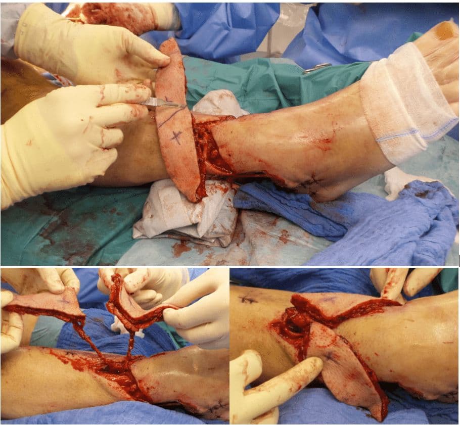 Case 19 2026: Split Perforator Flaps for bilateral ankle defects: A modern microsurgical approach to preserve function and reduce secondary thinning operations