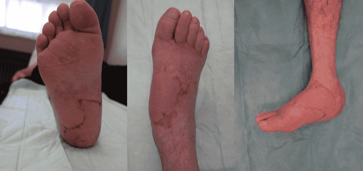 Case 2 - 2025: Reconstruction of an extensive foot defect using a combined sensory split latissimus dorsi and serratus anterior muscle flap