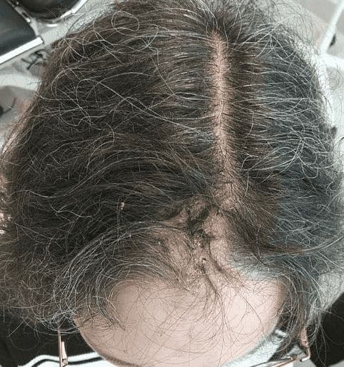 Case 20 2026: Staged Excision and Delayed Primary Closure of a large Nodular Basal Cell Carcinoma of the Anterior Scalp
