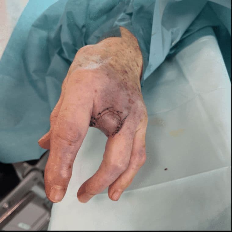 Case 23 2026: “Minimally Invasive Finger Amputation Using a Volar ‘Toilet seat’ Flap for Invasive Squamous Cell Carcinoma”
