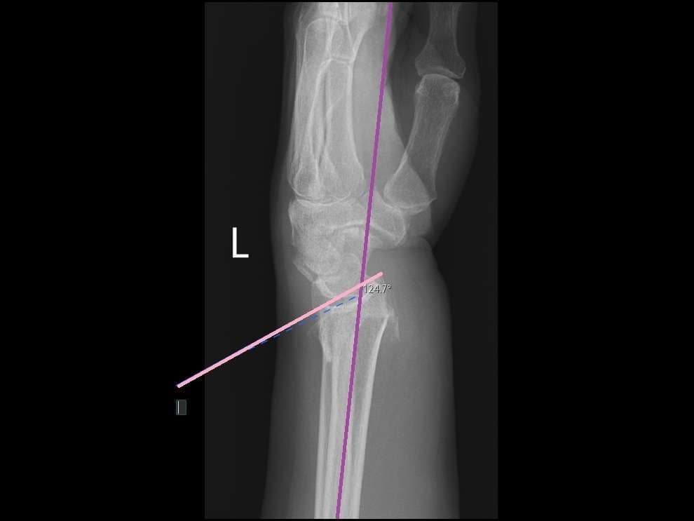 Case 25 2026: Closed Reduction of a Distal Radius Fracture in the Emergency Department