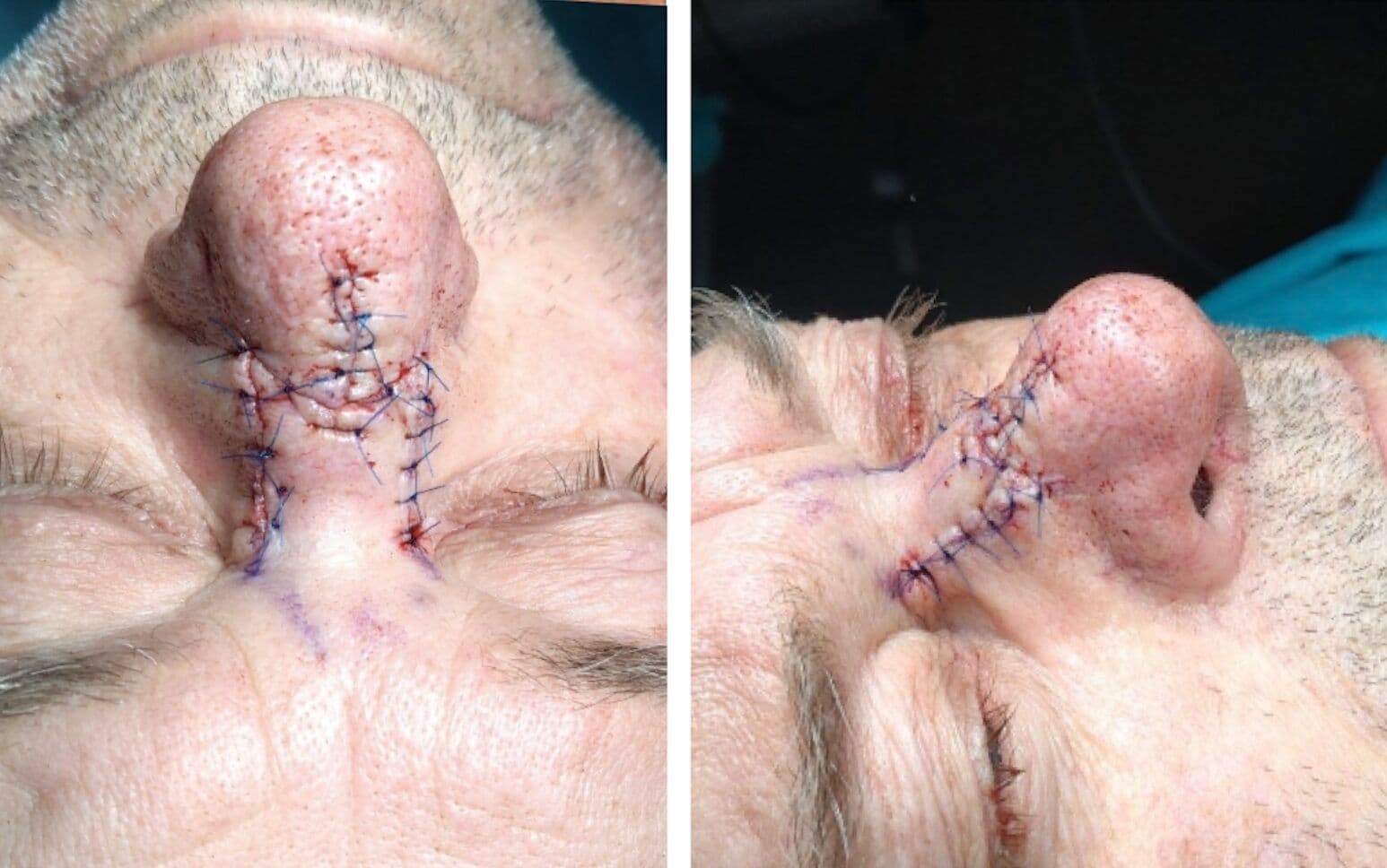 Case 26 2026: Dual-Hybrid Flap Advancement for Proximal Dorsal Nasal Reconstruction