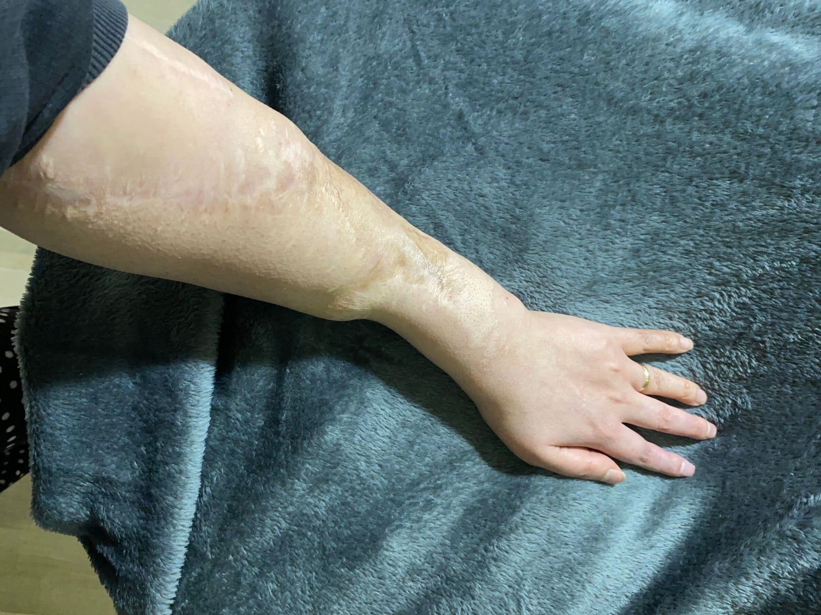 Case 03 2026: Emergency limb salvage with combined free vastus lateralis and anterolateral thigh flap after post-traumatic brachial artery graft thrombosis in a 16-year-old patient