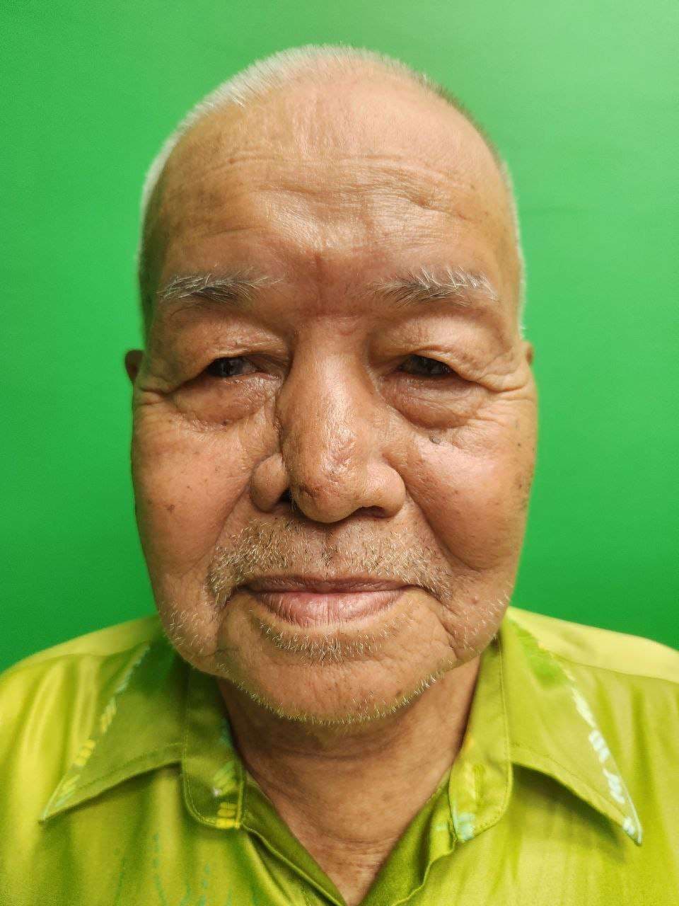 Case 3: Rieger-Marchac Dorsal Nasal Flap Revisited: An Old But Versatile Flap for Nasal Reconstruction