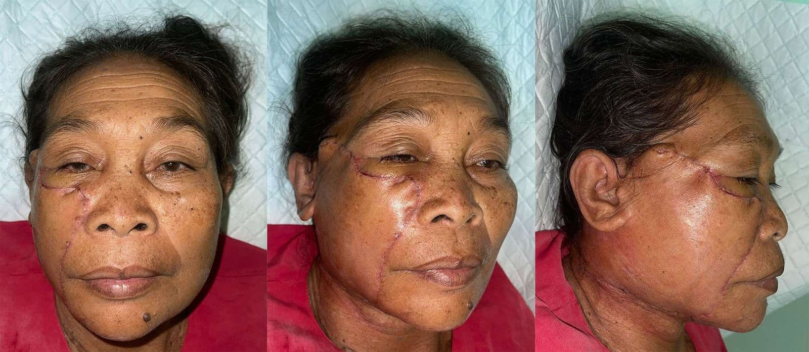 Case 7: Cervicofacial Flap for Cheek Reconstruction Post Excision of Pigmented Solid Basal Cell Carcinoma