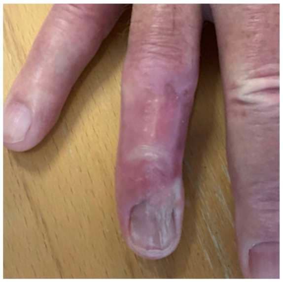 Case 9: Adipofascial Turnover Flap for Reconstruction of a Dorsal Finger Defect Following SCC Excision