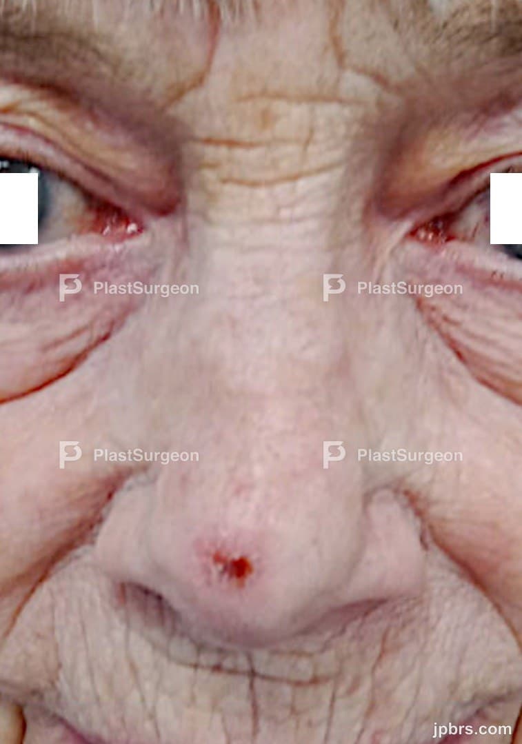 Case 7 (2024): Closure of larger tip defect by a modified Peng-Flap with extended Nasofrontal dissection
