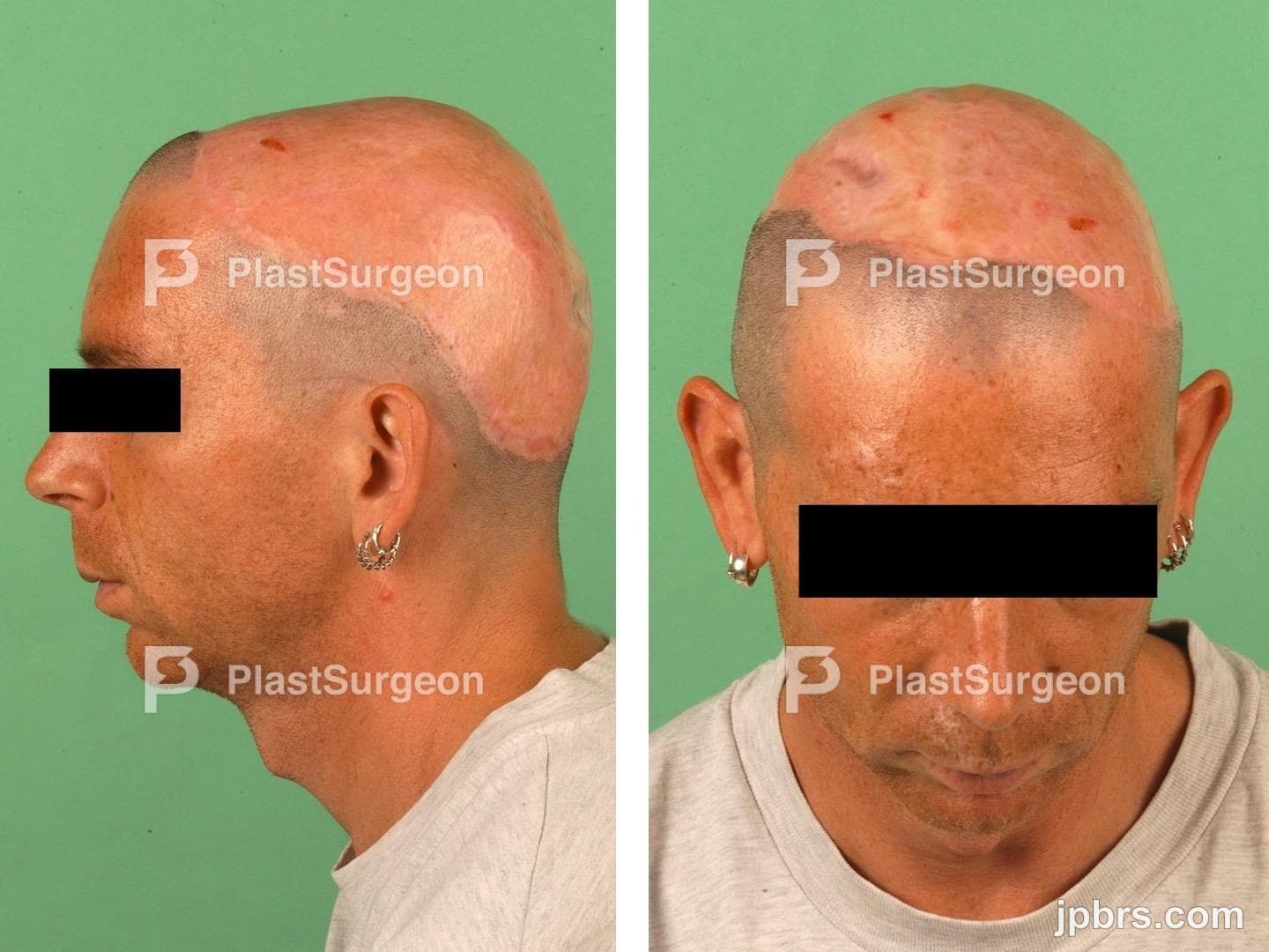 Case 4 (2023): Extensive scalp reconstruction using a free myocutaneus lattisimus dorsi flap