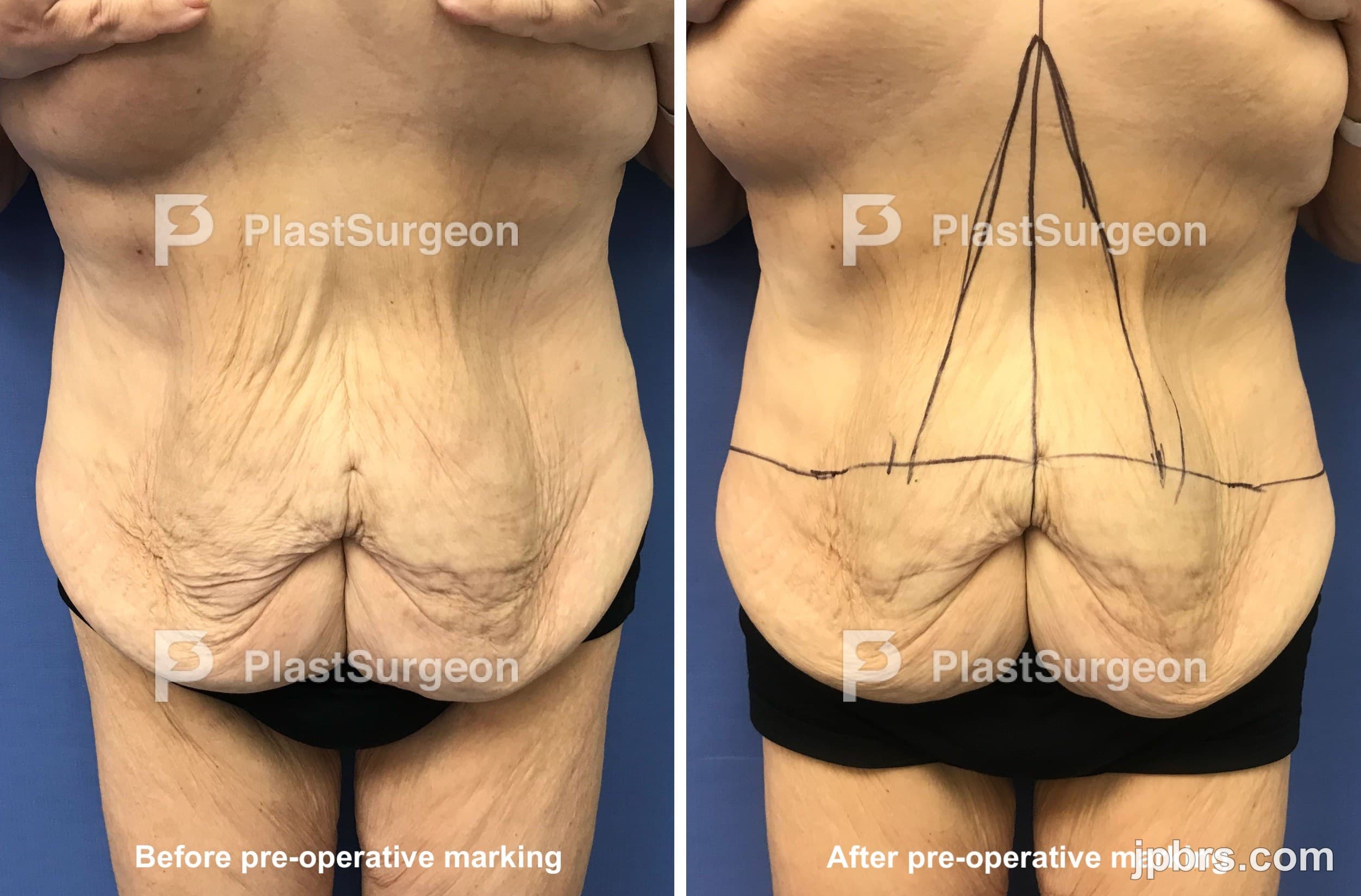 Case 12 (2024): Fleur-de-lis abdominoplasty
