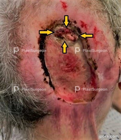 Case 14 (2024): Full-thickness scalp and skull defect with dura mater exposure due to dissociation of pain sensation and anankastic personality disorder