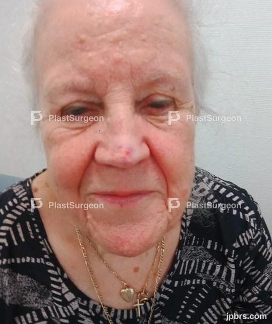 Case 6 (2023): Nasal reconstruction with bilateral nasolabial flaps