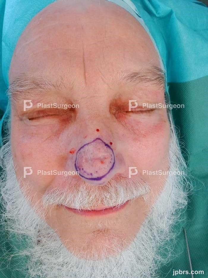 Case 11 (2023): Paramedian forehead flap for nasal soft tissue reconstruction