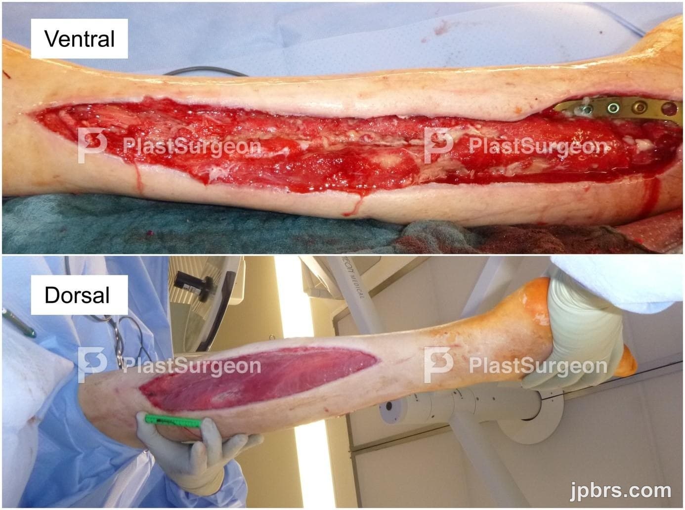 Case 19 (2023): Pushing the Limits of Lower Extremity Reconstruction: A Free Conjoined ALT and AMT Flap