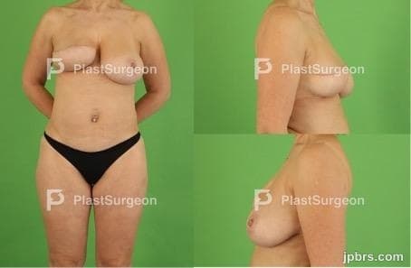Case 11 (2024): Pushing the Limits of Unilateral Autologous Breast Reconstruction: Bilateral TMG Flap with Immediate Nipple-Areolar-Complex Reconstruction