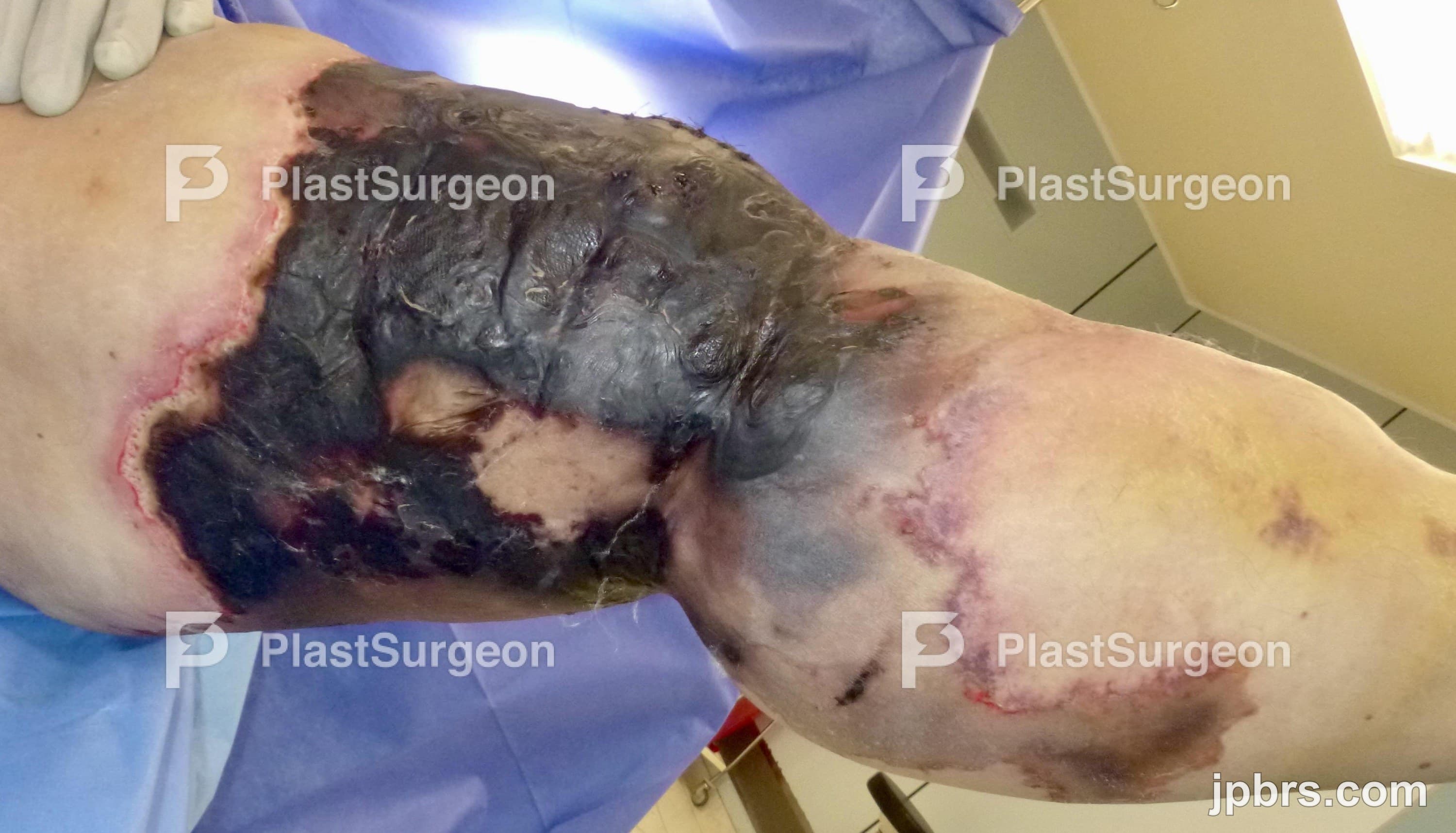 Case 3 (2023): Reconstruction of an extensive circumferential leg defect using a preconditioned bipedicular MS-2-TRAM Free Flap