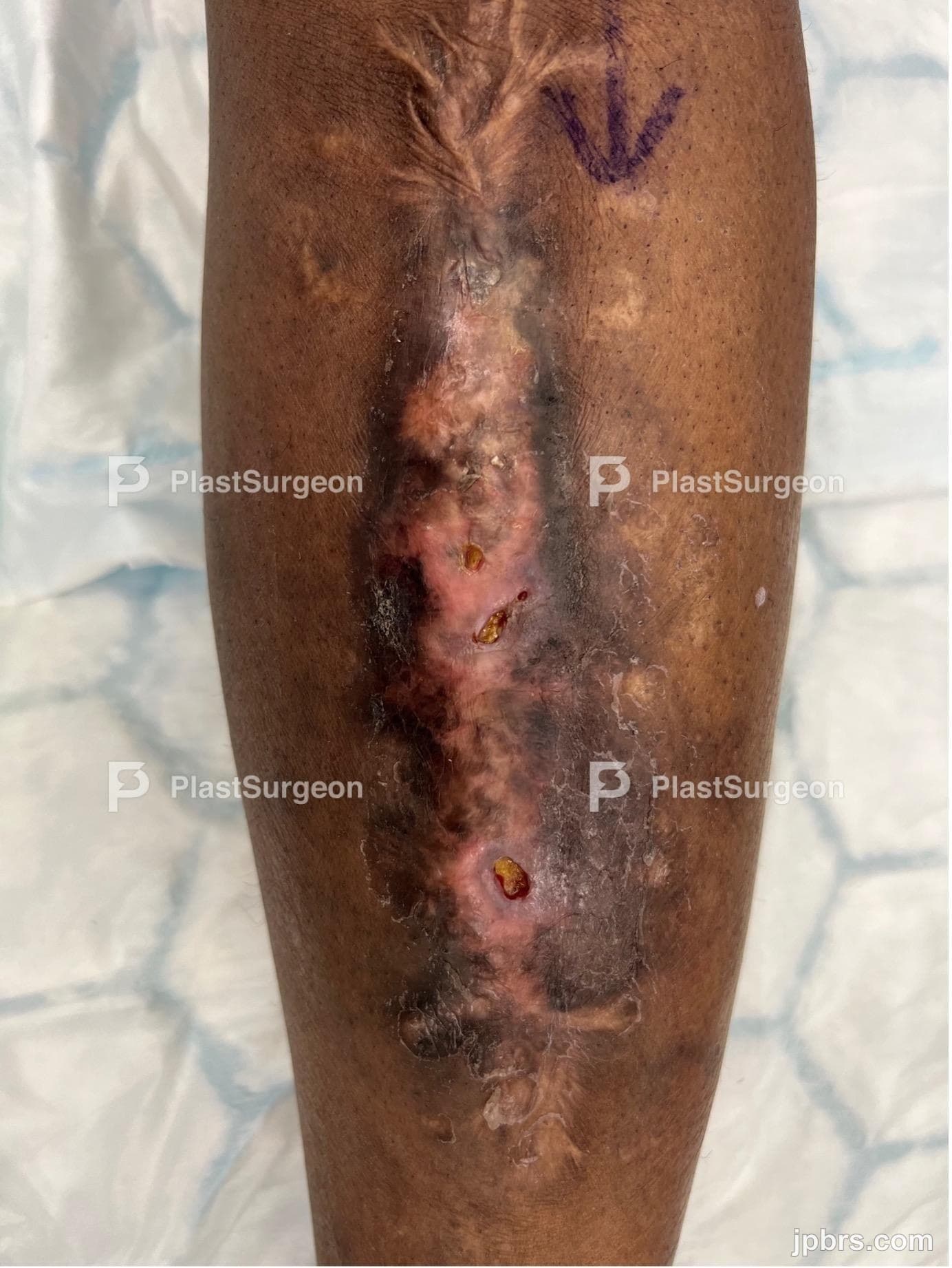 Case 16 (2023): Single-stage treatment of chronic osteomyelitis reconstructed with a free muscle flap