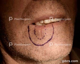 Case 15 (2024): Staircase flap reconstruction of the lower lip