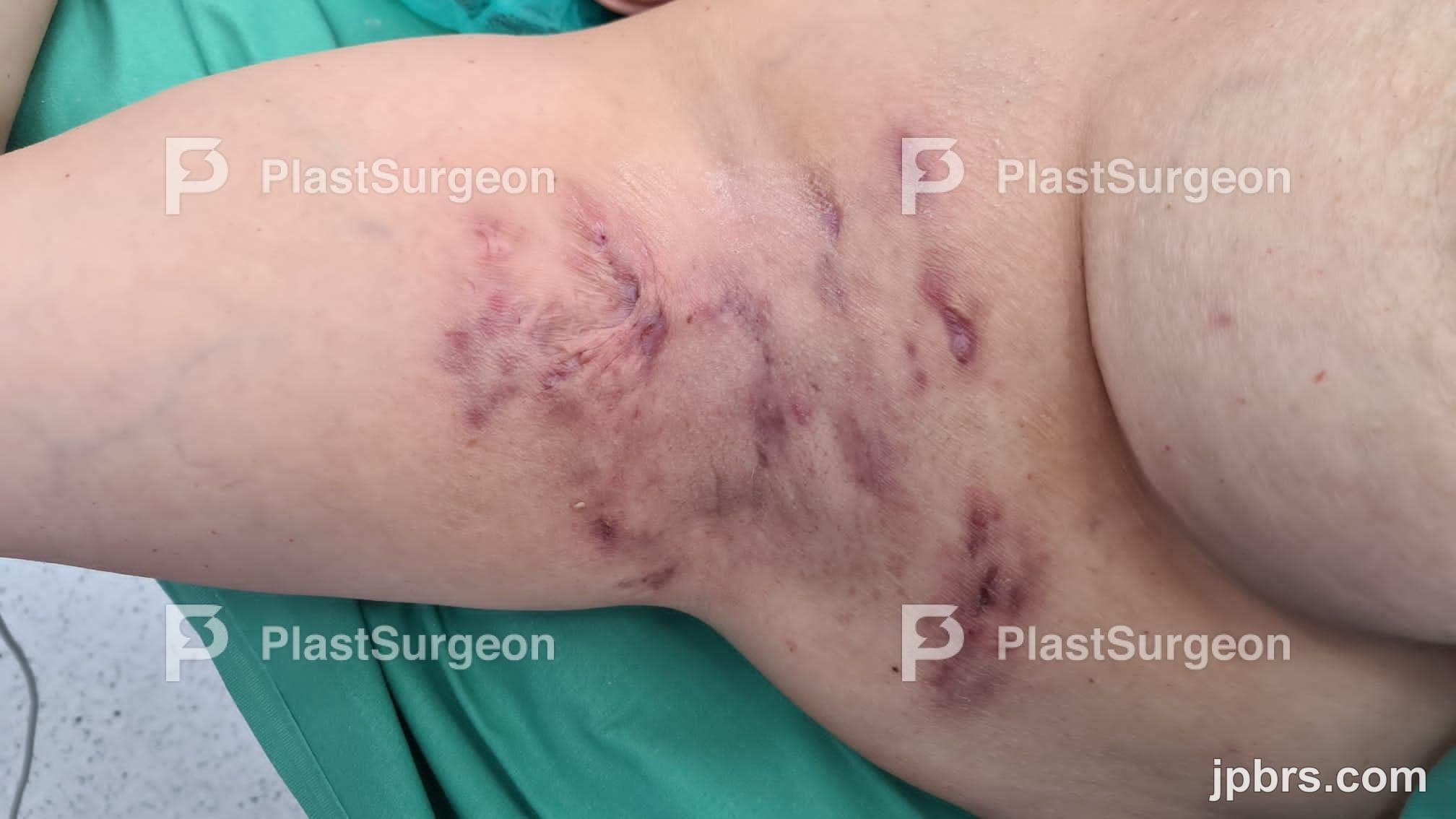 Case 18 (2023): Surgical management of hidradenitis suppurativa