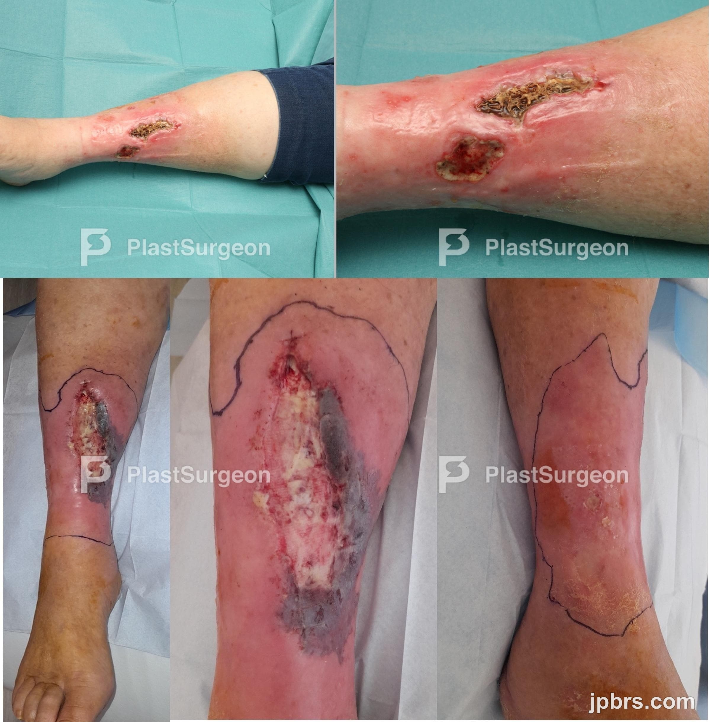 Case 3 (2024): Surgical Management of Soft Tissue Calcium Deposition in the Lower Limbs: A Case Report