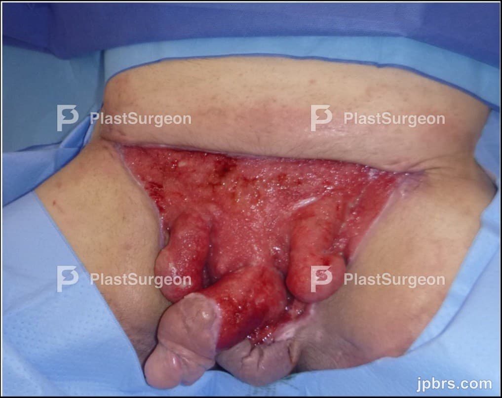 Case 9 (2024): Unconventional Reconstruction of a Complex Genital Defect