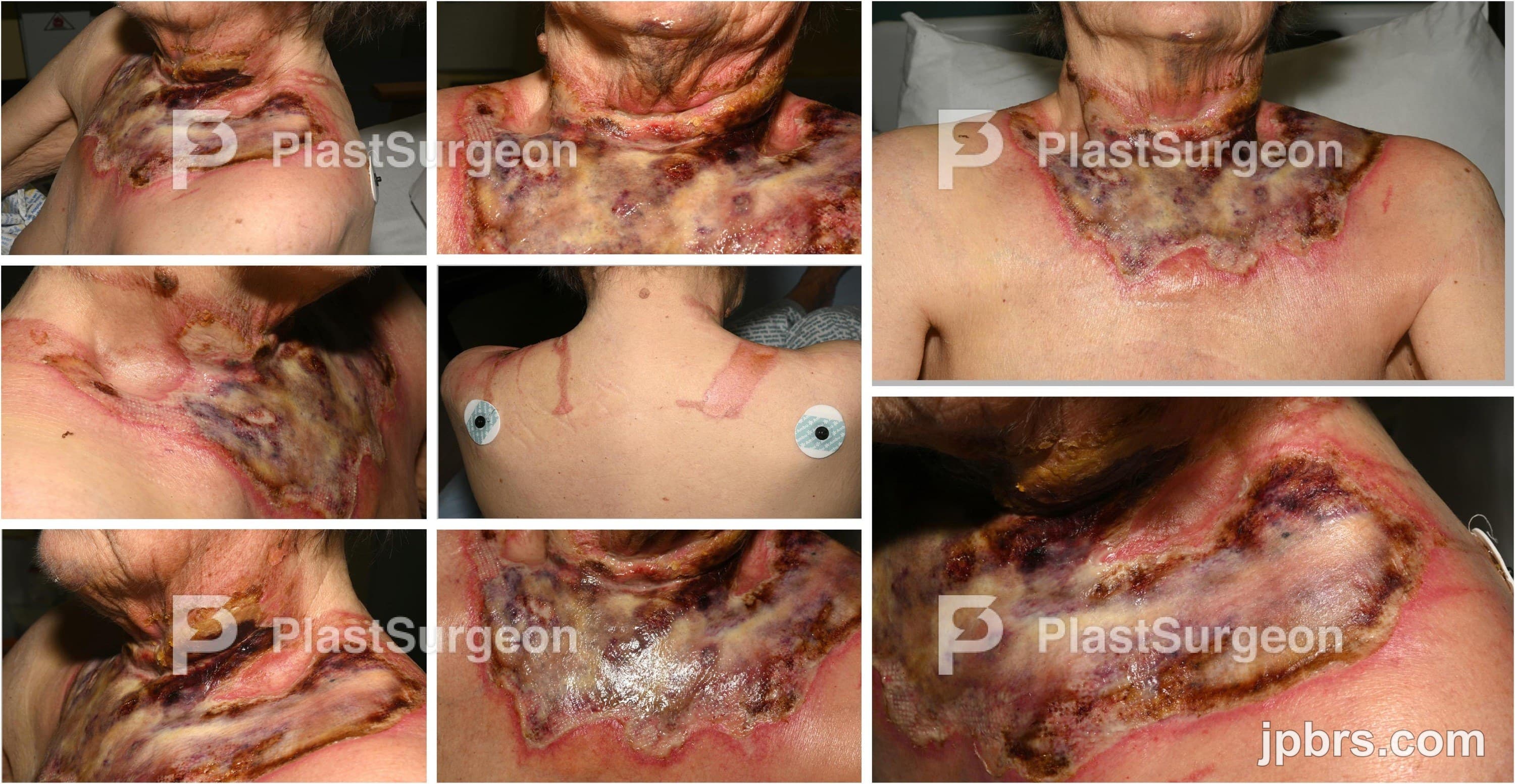 Case 4 (2024): Wound healing and dermal regeneration in delayed presentation of a burn patient treated with NovoSorb® Biodegradable Temporising Matrix: A Case Study